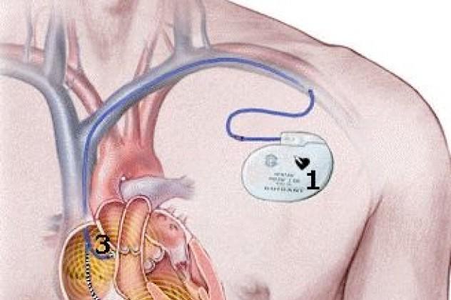 Βηματοδότης Ο βηματοδότης είναι μία εμφυτεύσιμη συσκευή που βοηθάει στη ρύθμιση των αργών καρδιακών χτύπων (βραδυκαρδία).