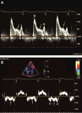 1) An L-wave is very often an unnoticed finding. 2) The L-wave may be seen in relatively bradycardic patients with normal hearts.