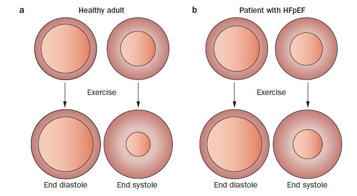 LV systolic limitations However, with exercise stress, the increase in ejection fraction is blunted in the patient with HFpEF owing to the inability to contract to as low an end-systolic volume,