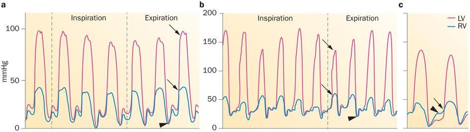 echocardiography and confirmed by MRI or CT (2) restrictive Doppler findings of transmitral and/or pulmonary venous flow