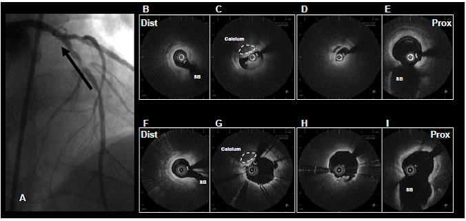 αμέσως μετά την εμφύτευση stent σε ασθενή που παρουσιάζει οξύ έμφραγμα του μυοκαρδίου, η Εικόνα 8 απεικονίζει ατελή εναπόθεση strut, όπως συχνά παρατηρείται με χρήση OCT αμέσως μετά από τοποθέτηση