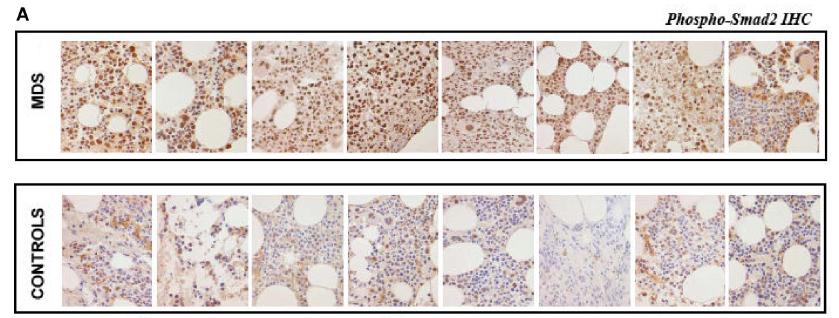 TGF- β signalling in Myelodysplasia Higher TGF- β In MDS OveracFve SMAD2 Reduced