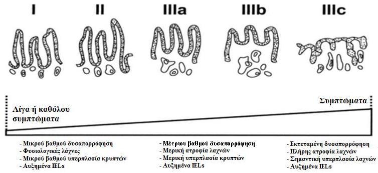 Εικόνα 3: Φάσμα δυσαπορρόφησης και συμπτωμάτων στην κοιλιοκάκη, σε συσχέτιση με την έκταση της ιστολογικής βλάβης του εντερικού βλεννογόνου (όσο πιο εκτεταμένη είναι η βλάβη του βλεννογόνου, τόσο