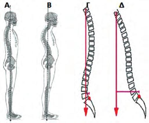 Διάχυτη Ιδιοπαθής Σκελετική Υπερόστωση-DISH: Δ. Πάλλης, Ι. Τριανταφυλλόπουλος της σπονδυλικής στήλης, είναι η μυελοπάθεια και η στένωση του αυχενικού σπονδυλικού σωλήνα. Εικόνα 7. Α.
