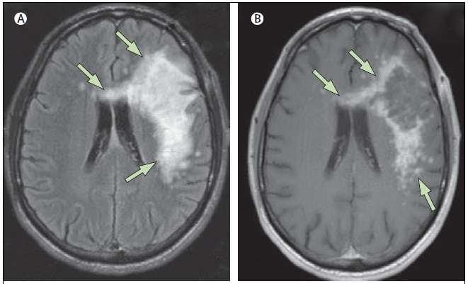 JCV: CSF: JC virus DNA in CSF by PCR brain tissue: in situ nucelid acid hybridization,
