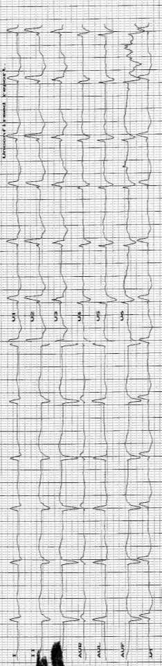 κολπική μαρμαρυγή, 60 bpm διδεσμιδικός αποκλεισμός