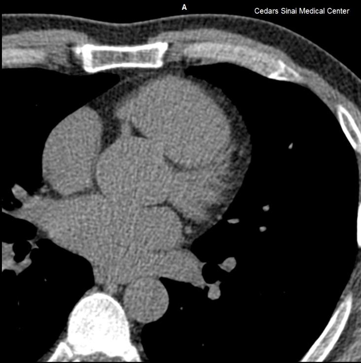 Calcium Score Provides an estimate of overall atherosclerotic burden Ca ++ score= 0 No