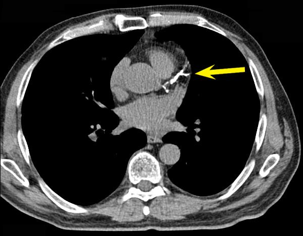 risk of CAD Up to 80% chance of inducible ischaemia on stress testing Higher CAC in Diabetes