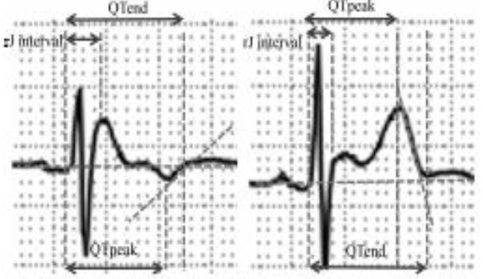 Risk Stratification of Ventricular Fibrillation in Brugada Syndrome Using Noninvasive Scoring Methods 143 ασθ με ιστορικό κοιλιακής μαρμαρυγής (n=35) και χωρίς κοιλιακή μαρμαρυγή (n = 108),