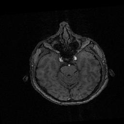 (MRI εγκεφάλου) με 5 ζεύγη ομολόγων σημείων που έχουν