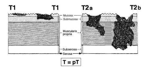 T4 Διήθηση των γειτονικών δομών (σπλήνας, εγκάρσιο κόλον, ήπαρ,