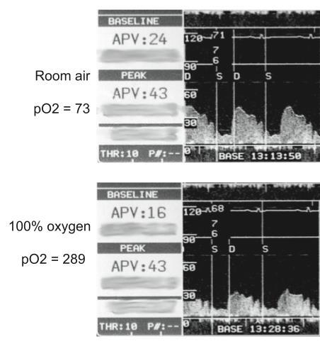 MONA...PaO2 is a major determinant of coronary artery tone.