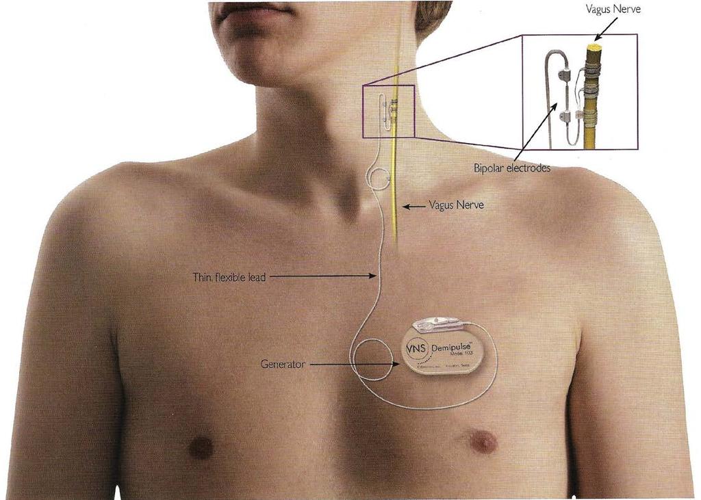 Αριστερό πνευμονογαστρικό νεύρο Ερέθισμα: 30 sec κάθε 5 min συνεχώς 24 h, 20-30 Hz Μετά την εμφύτευση γίνονται τακτικοί