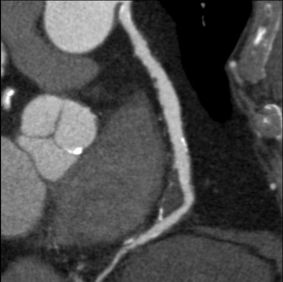 Coronary Imaging 66 year old patient S/P