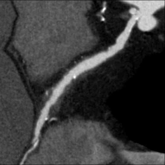 demonstrates a focal aneurysm (yellow