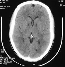 Απεικόνιση - Ι Αξονική τομογραφία εγκεφάλου Εξάλειψη του βάθους των