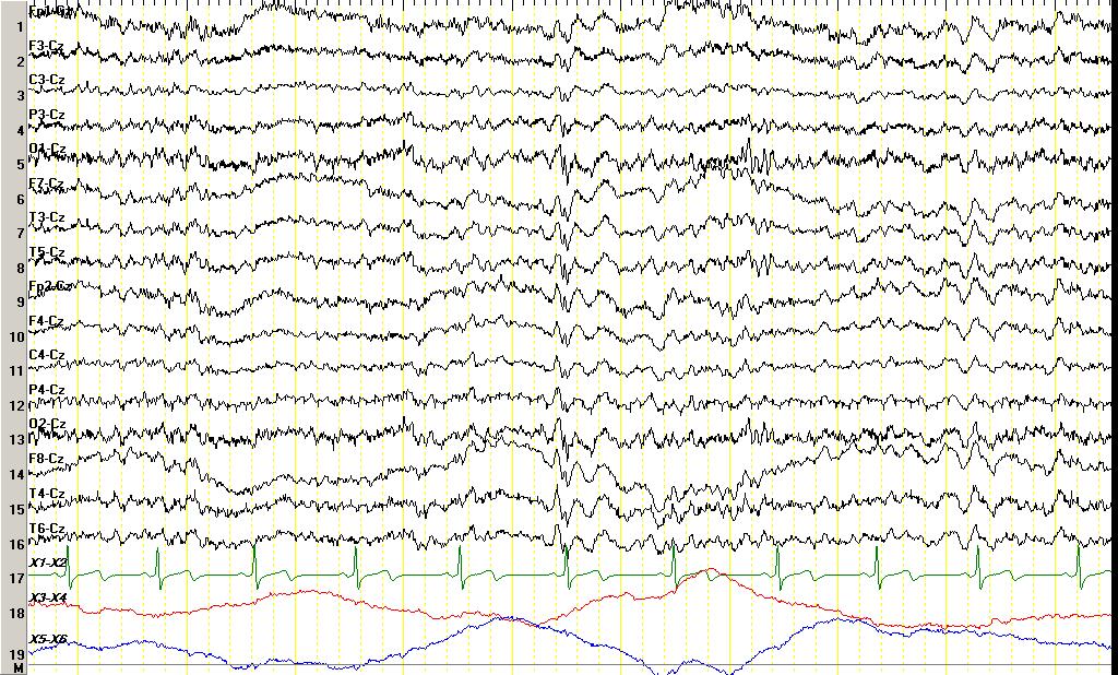 Γυναίκα 18 ετών, 6 Hz αιχμή κύμα,