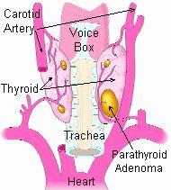 http://parathyroid.