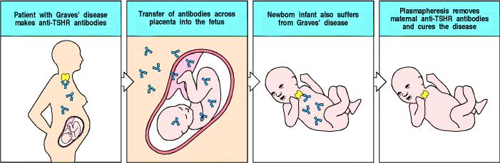 Antibody-mediated AUTOIMMUNE diseases can appear IN THE INFANTS OF AFFECTED MOTHERS as a consequence of transplacental antibody transfer https://www.coursehero.