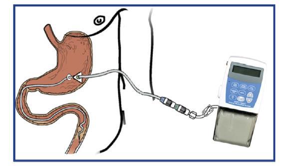 Levodopa-entacapone-carbidopa intestinal gel in Parkinson's disease: A