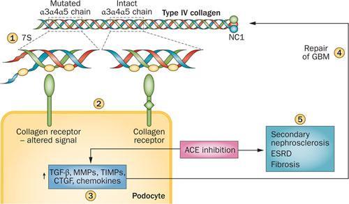 Alport syndrome Σπάνια γενετική ασθένεια ΒΑΣΙΚΗ ΜΕΜΒΡΑΝΗ 1927- Arthur C.