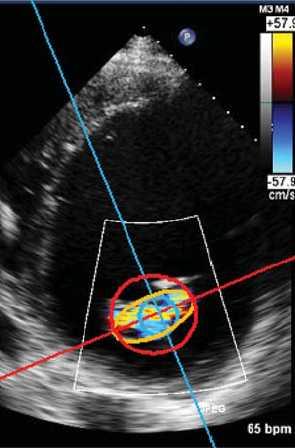 circular orifices in FMR: