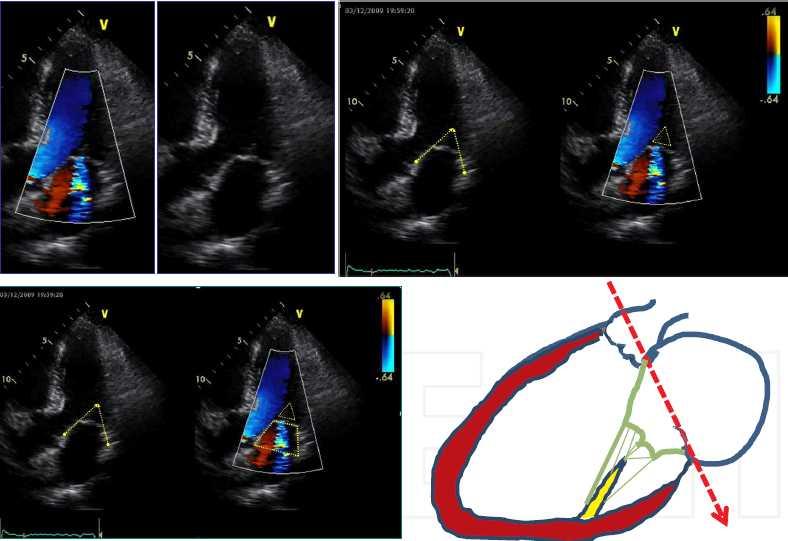 Mitral regurgitation with distorted mitral valve geometry: trapeze (IIIB)