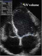 left ventricular