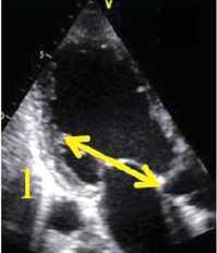 Echo assessment of FMR: