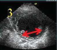 posteromedial papillary