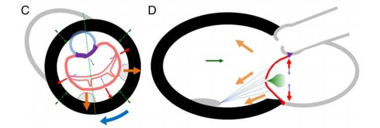 Phenotypes of FMR: Symmetric Model global LV dilatation spherical remodelling enlarged mitral annulus displacement both PMs posteriorly, laterally, apically tethering of both