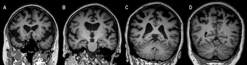 Φλοιοβασική εκφύλιση (CBD) MRIs of CBS. Coronal T1-weighted MRI demonstrates atrophy of the dorsolateral frontal cortex (A), peri-insular region (A and B), and parietal lobes (C and D).