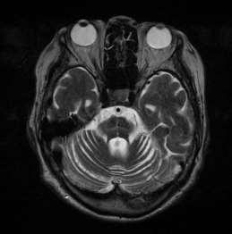 A neurological syndrome associated with orthostatic hypotension: a clinical-pathologic study.