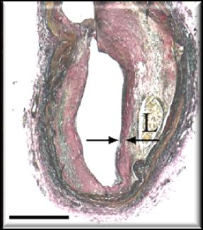 παρουσίας ευάλωτης πλάκας n=35 lipid-rich