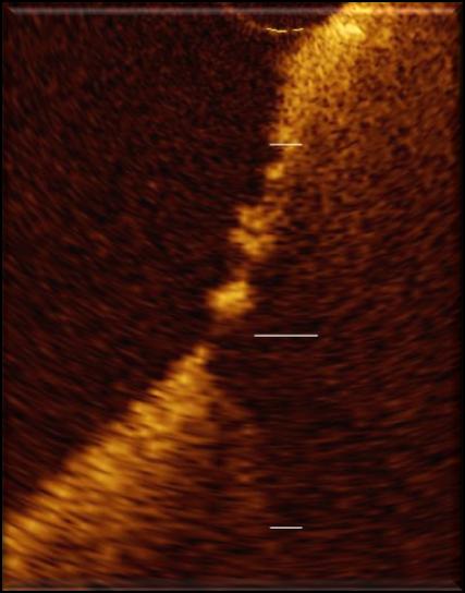 histology: -24±44 µm Kume et al, Am Heart J