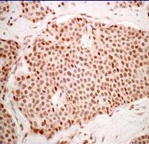 (Chromogranin A) Median Progression Free Survival (months)