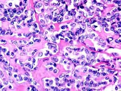 Εικόνα 7: Απεικόνιση του Μυελοειδούς Καρκίνου του Θυρεοειδούς, με άφθονο αμυλοειδές (Papanikolaou Society of Cytopathology, http://www.papsociety.org/atlas/displayimage.php?album=46&pos=11).