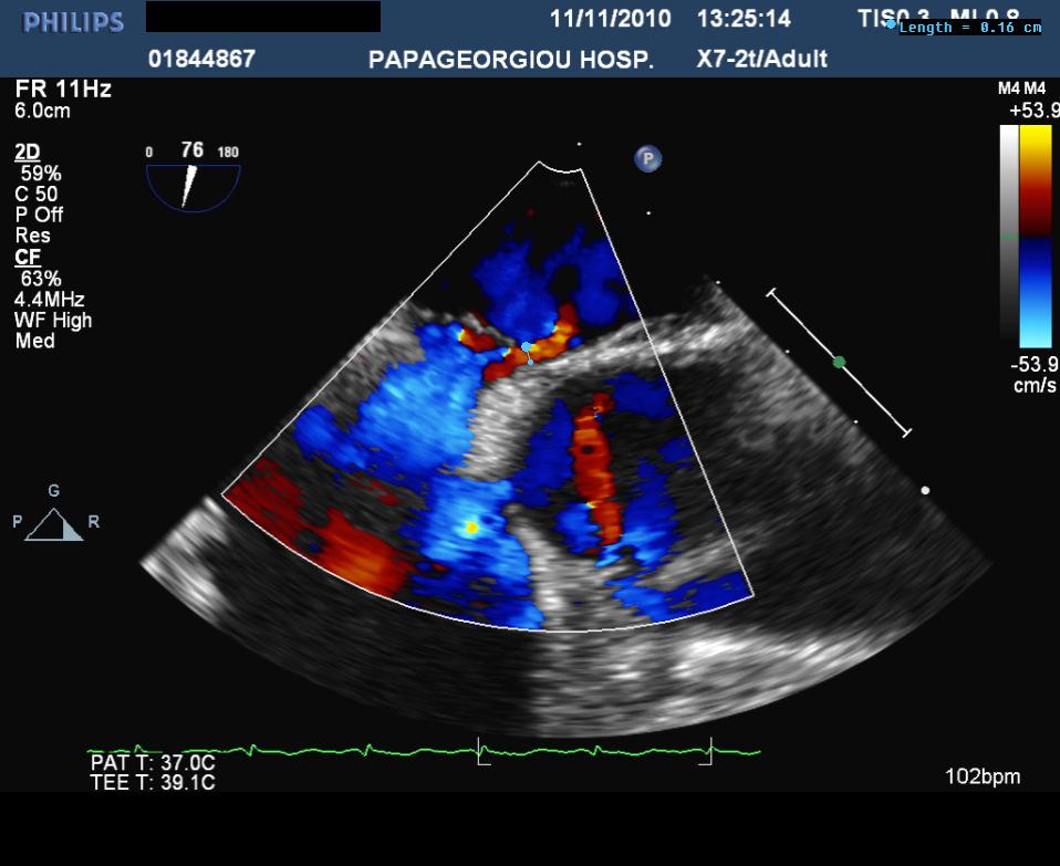 2. Έλεγχος στον αριστερό καρδιακό κόλπο για την παρουσία µικροφυσαλίδων. 3. Τέλος µέτρηση και καταγραφή της µέγιστης διαµέτρου του διαγνωσθέντος ΑΩΤ. Εικόνα 16.