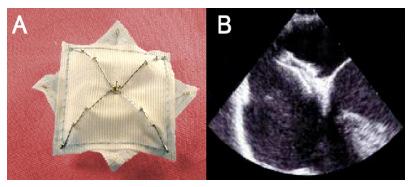 Εικόνα 3. (Α) Απεικόνιση εµφυτεύµατος για τη σύγκλειση του ανοικτού ωοειδούς τρήµατος. (B) ιοισοφάγειο υπερηχοκαρδιογράφηµα των κολπικών κοιλοτήτων.