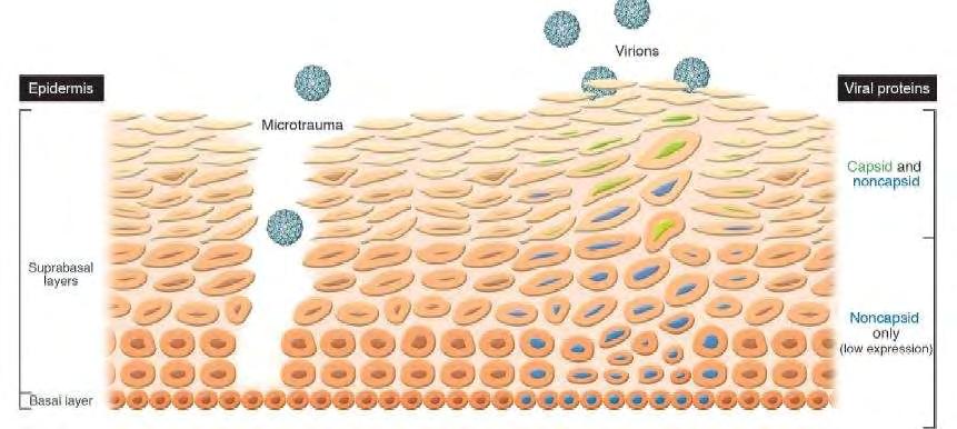 Εικόνα 7. Απελευθέρωση των νεοσχηματιζόμενων ιικών σωματιδίων από το κερατινοποιημένο έχει σχηματιστεί στα μολυσμένα κύτταρα της ανώτερης επιθηλιακής στοιβάδας.