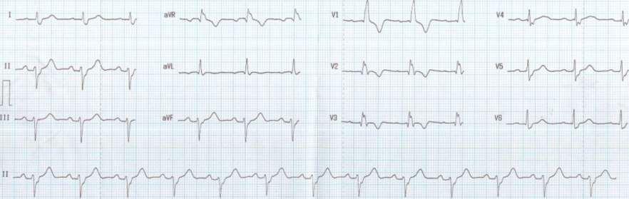 RBBB and