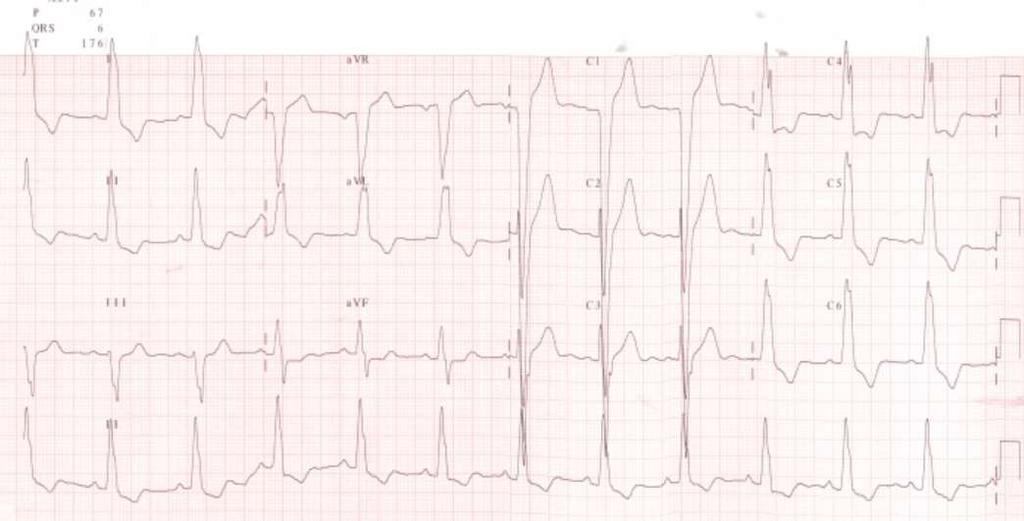 LBBB