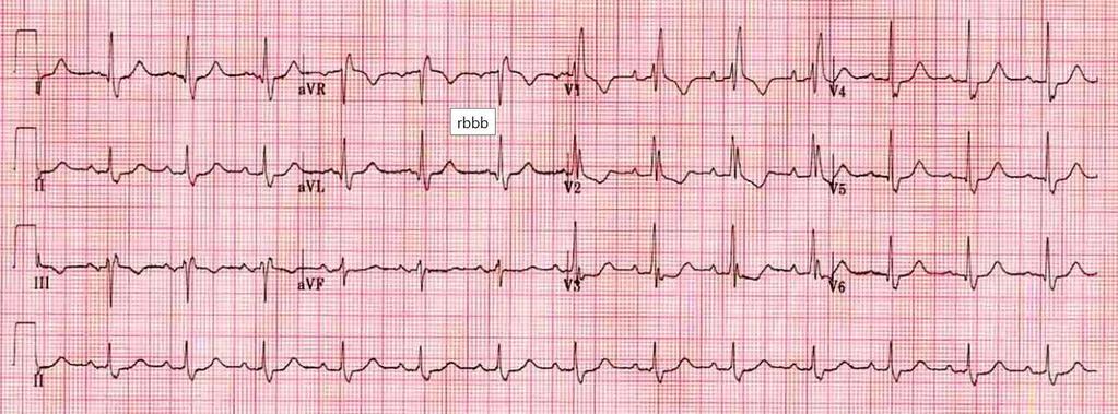RBBB