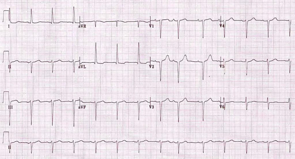 Left anterior