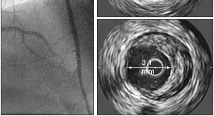 evidence of disease Atheroma IVUS=intravascular