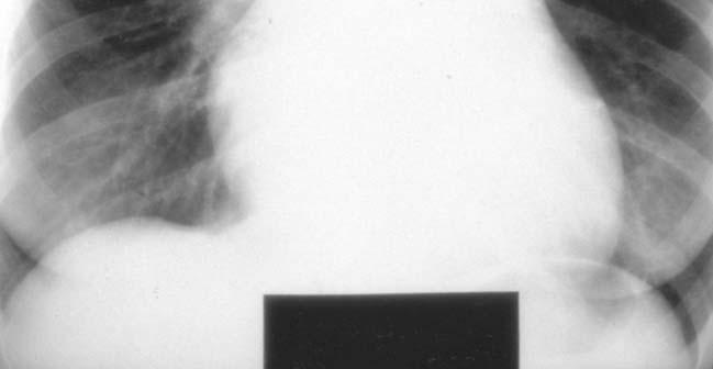 PAP < 15 mmhg Consequences Right ventricular hypertrophy Right heart failure Dyspnea,