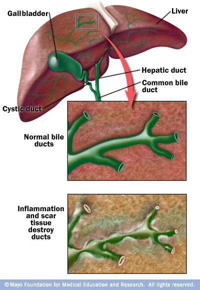 Χρόνιο χολοστατικό νόσημα (medium + large bile ducts) Φλεγμονώδης και ινωτική διεργασία σε ενδο- και εξω- ηπατικά