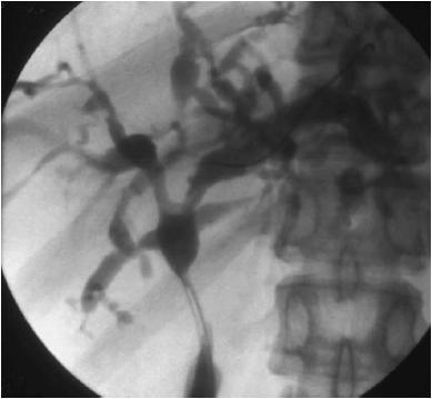 ERCP Διάγνωση(2) Χολαγγειογραφία MRC,ERC: πολυεστιακές στενώσεις χοληφόρων με