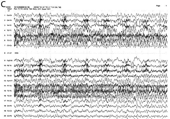 Τυπική εσω κροταφική κρίση (συν 2) Επέκταση στις αριστερές κεντρικές περιοχές και εξέλιξη σε