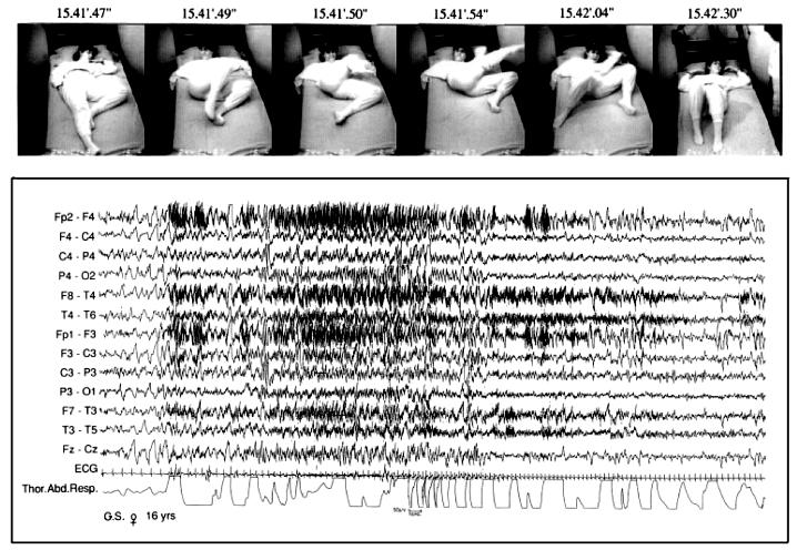 The patient violently rocks her legs, presents a dystonic posture of the arms and an asymmetric grimace. The seizure lasts 40 s. Polysomnograph: the seizure arises during slow wave sleep.